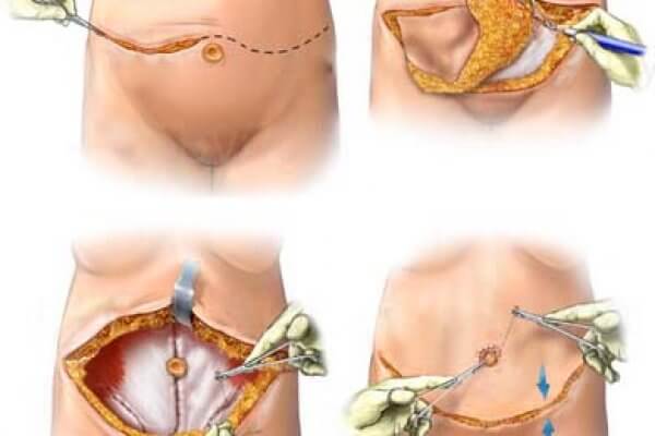 Abdominoplastika