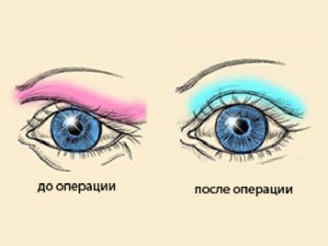 Blefaroplastikadan keyin Osiyo qopqog'i