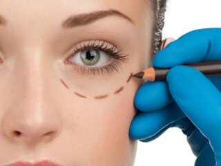 Pastki blefaroplastika