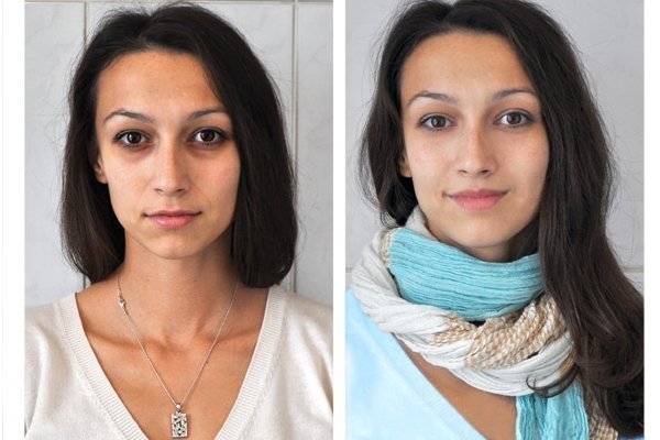 jarrohlik bo'lmagan ko'z qopqog'ini ko'tarish