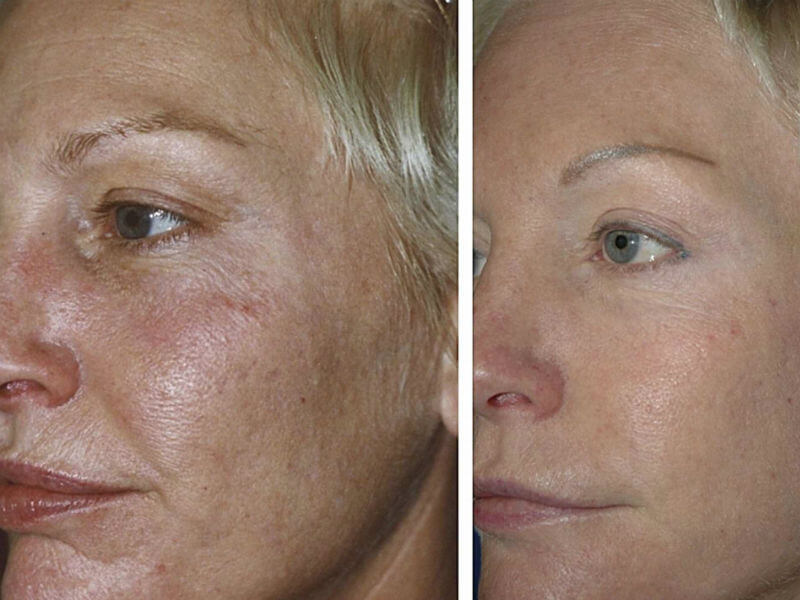 Blefaroplastika usulidan reabilitatsiya qilinganidan so'ng