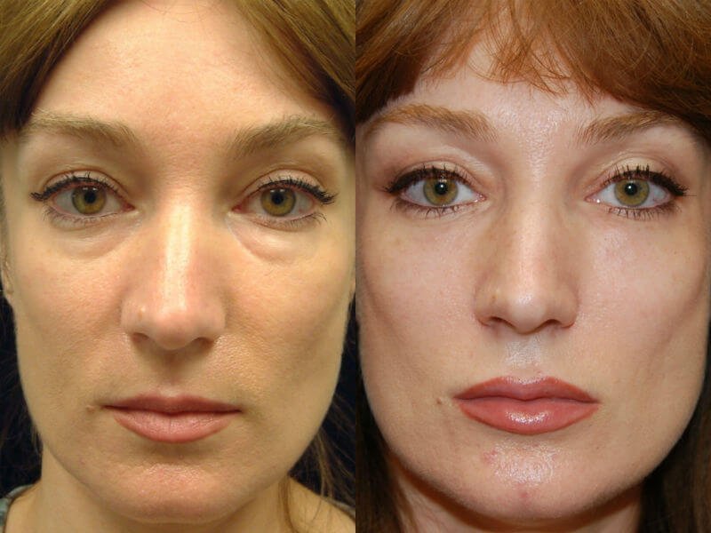 Blepharoplastyadan so'ng ko'z qovoqlarini lazerlash