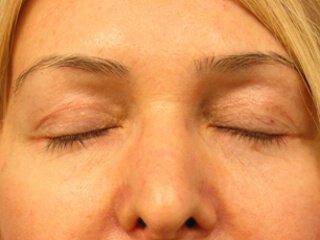 Blefaroplastikadan keyingi tikuvlar