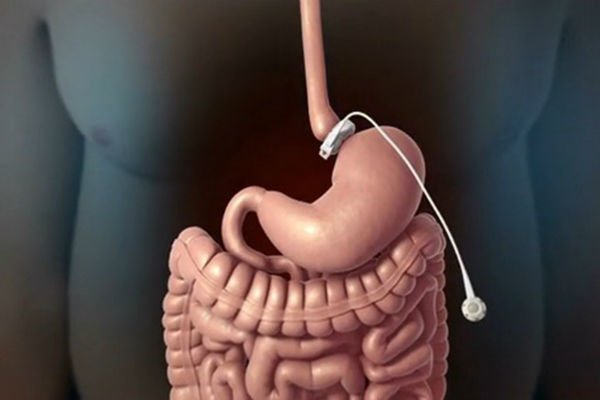 Oshqozon qisilishi operatsiyasi