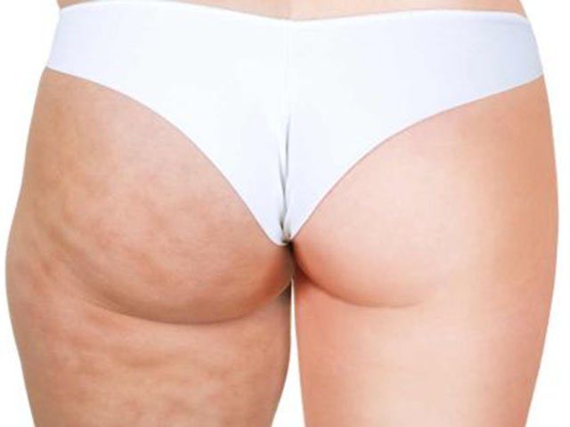 Yog 'kalçasından qutulish yo'llari