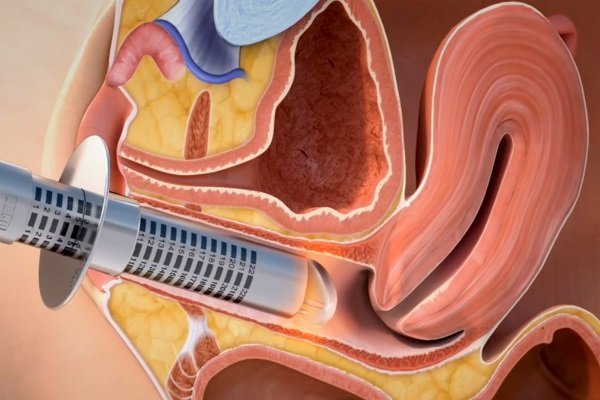 Lazer vaginal qisqarish