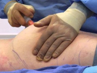 Lipofilling qoldiqlari