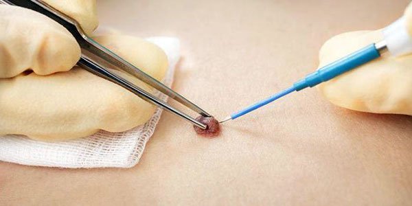 Olib tashlash jarayoni