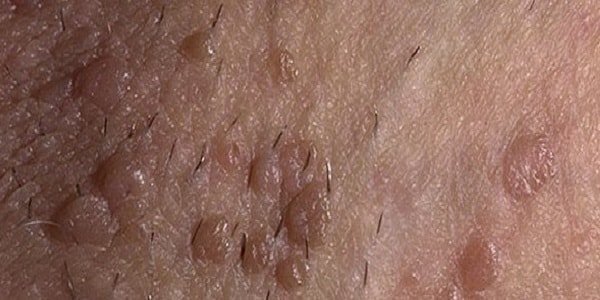 Yaqin joylarda papillomalar