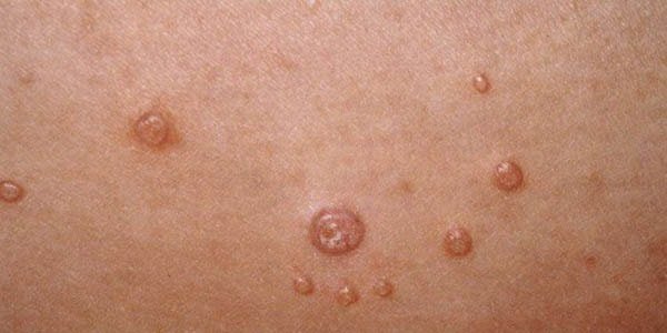 Papilloma ko'rinishi