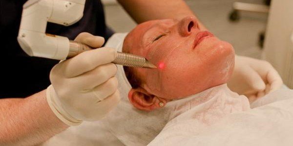 Lazer yuzni silliqlash