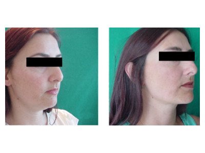 Yanak tuzatishdan keyin o'zgartirish