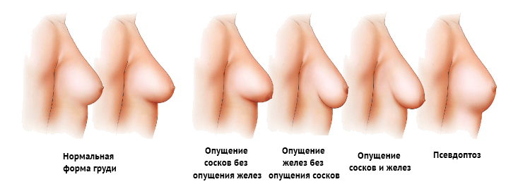 Ko'krak etishmovchiligining turlari