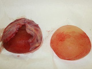 Mammoplastikadan keyin implantlarni almashtirish