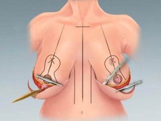 Ko'krakni kamaytirish operatsiyasi