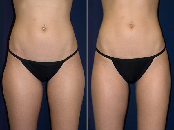Hip liposuction natija