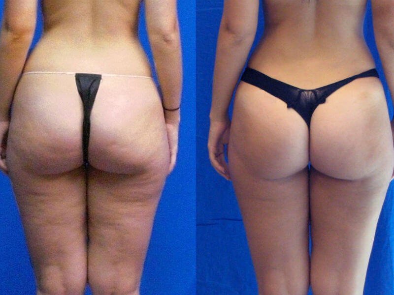 Yuqori tayoq plastmassalari