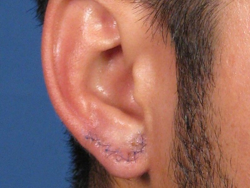 Quloqlarda tunnellarni qanday qilib tikish mumkin