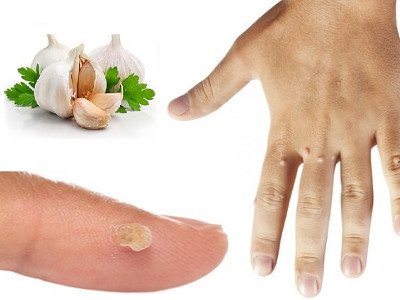 Xalq usullari bilan fasiyal tolalarni olib tashlash