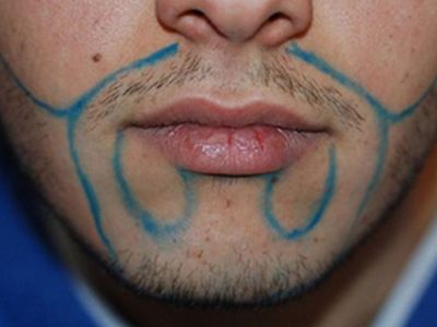 Soqolda sochlarni joylashtirish jarayoni