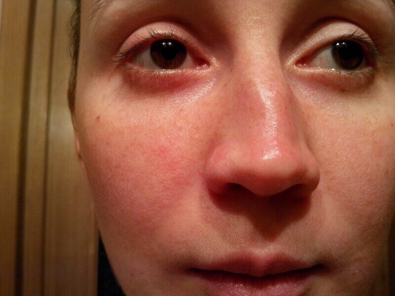 Burun septum lazerini tuzatish uchun ko'rsatmalar