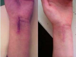 Yara izlari lazerni qayta tiklash