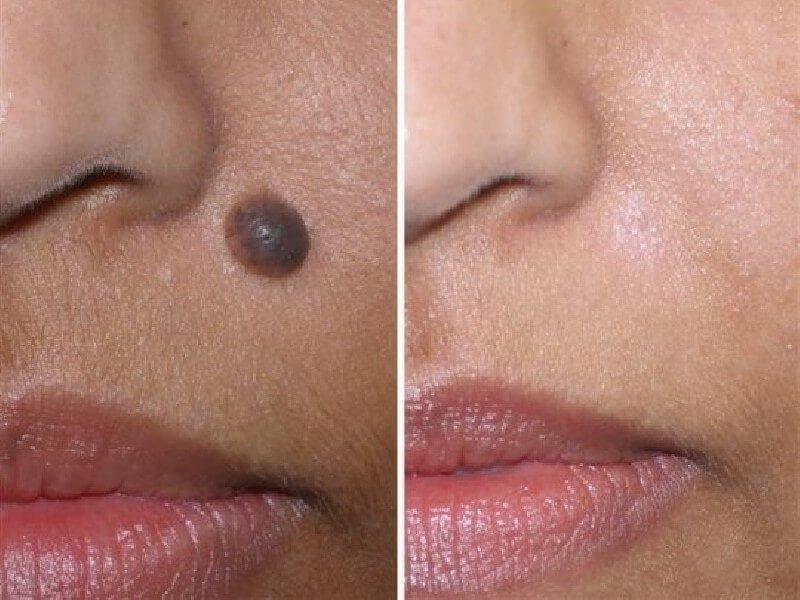 Lazerni yo'qotish natijalari